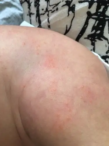 刚才给宝宝换尿不湿的时候突然发现他大腿根和背部长了这些红痘痘是什