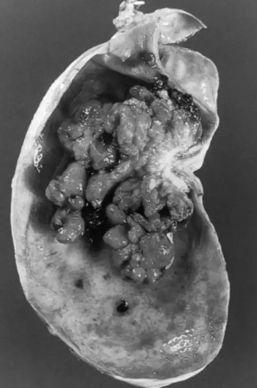 关注胆囊息肉令人闻风丧胆的病变