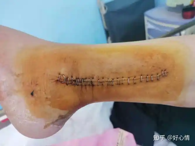 左腿胫腓骨粉碎性骨折,有内固定,但未拆除,已经在单位认定为工伤,这种