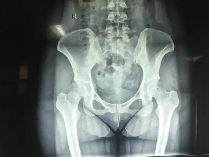 髋关节镜微创手术治疗股骨髋臼撞击症