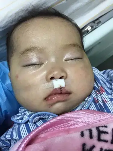 唇裂宝宝成长记2