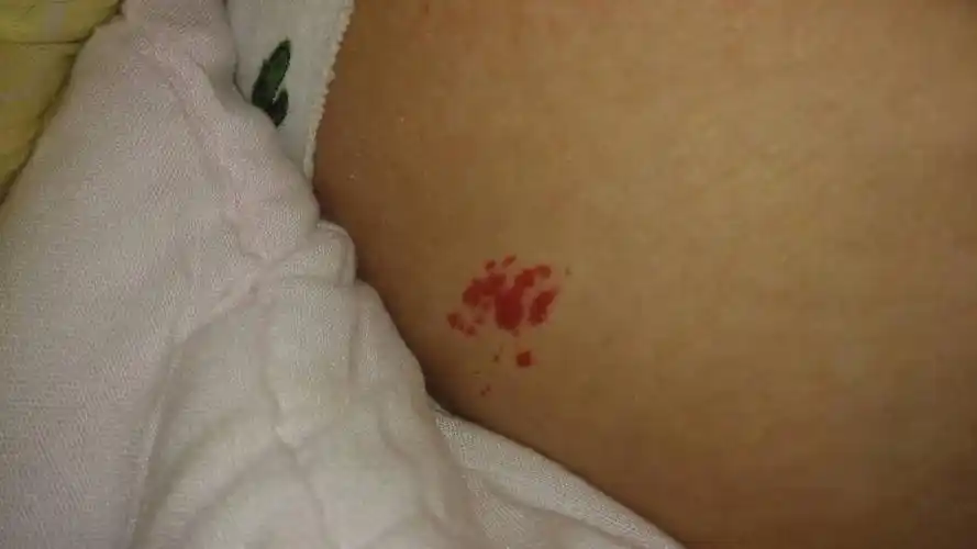 一般宝宝多大了这个血管瘤会自己下去?