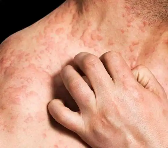 痒痒痒,实在太痒了!夏季,过敏,荨麻疹高发期该如何防御?