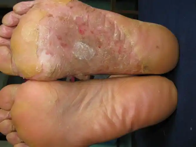 看图识病-------慢性湿疹