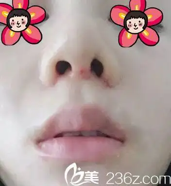 膨体隆鼻7天拆线后效果图
