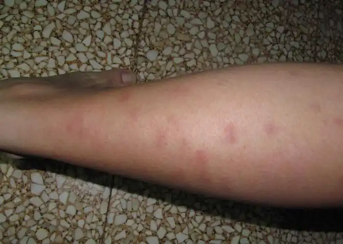 是小腿湿疹的一种.而且湿毒已经蕴藏在血液中了,所以才会这样.