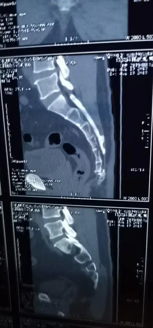 尾推骨折能评几级伤残