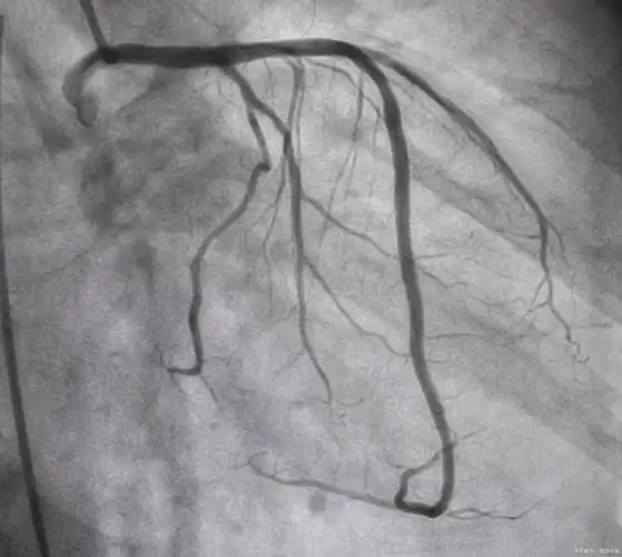 肾衰竭患者能造影吗