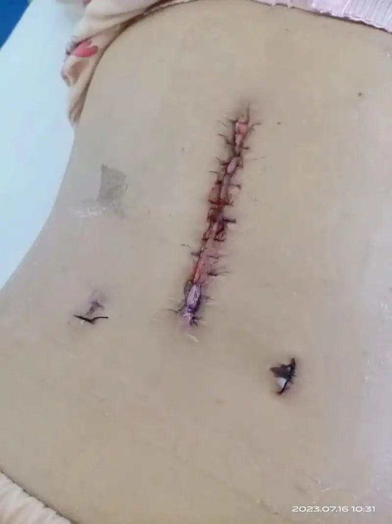 鬼知道我经历了什么 .伤口缝合…… - 抖音