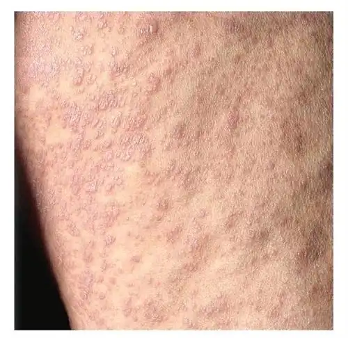 龟头扁平苔藓症状表现