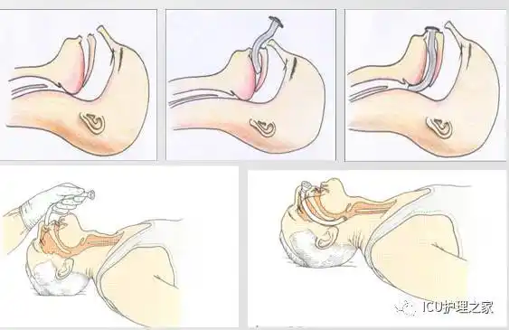 口咽通气管置管优缺点优点:易插入,使用方便且迅速,可防止舌和咽部软