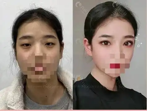 割双眼皮后会不会留疤我的眼综合对比照你来看值吗