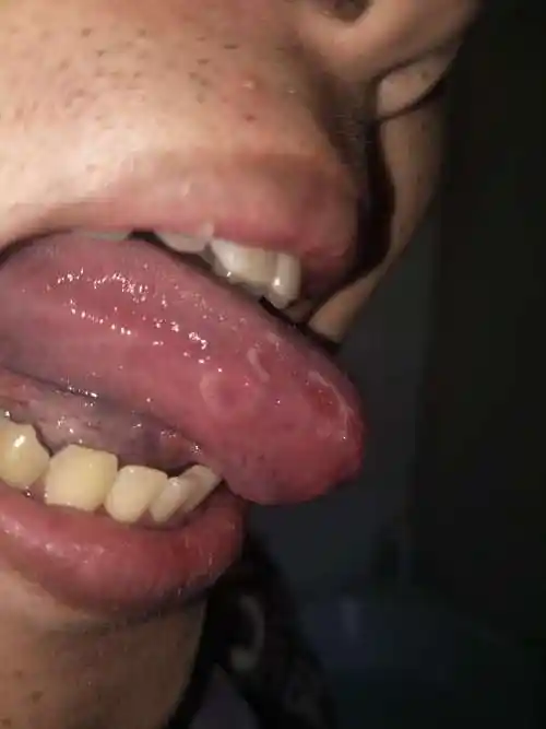 舌头上经常有这种白色的东西,请大夫帮我看看这是不是艾滋病的舌头啊