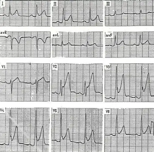 早期复极综合征的三种心电图表现你都掌握了吗