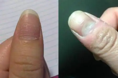 手指甲凹凸不平是什么原因 几个致病因素你要了解