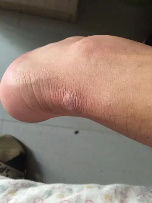 跟腱下方搔抓起硬结,并奇痒无比(已锁帖,患者咨询请微信搜索公众号:来