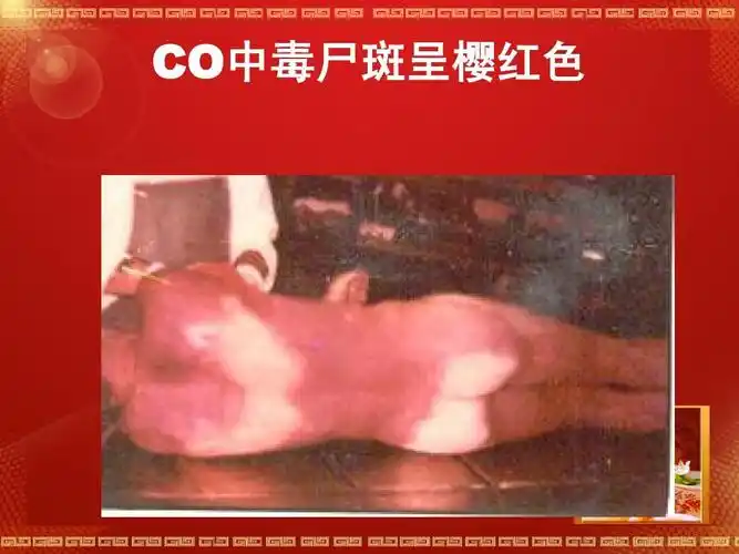 co中毒尸斑呈樱红色 co中毒尸斑呈樱红色
