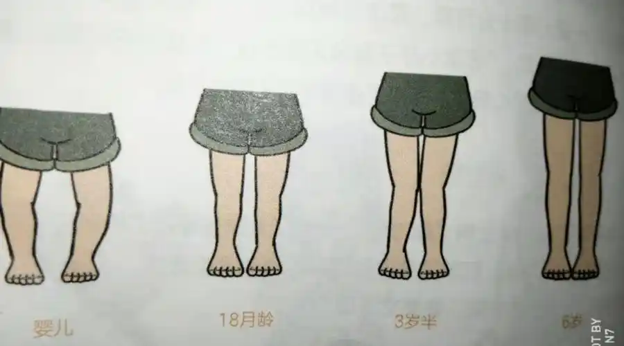事实上,很多宝宝在一岁前出现胫骨弯曲,2岁前都有o型腿
