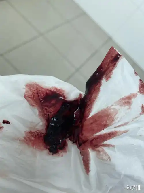 8mm残留,医生建议清宫,我想月经后带出,有希望吗? - 知乎