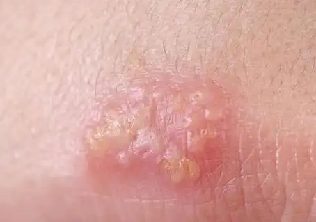 单纯疱疹图片与症状图片