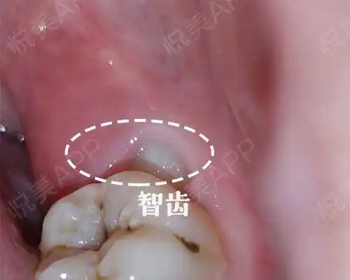 横着斜着倒着长智齿让你怀疑人生