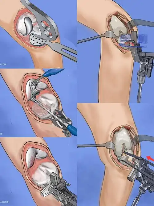 神农医院骨病骨伤科完成我市首例,吉林省第三家,膝关节单髁置换手术
