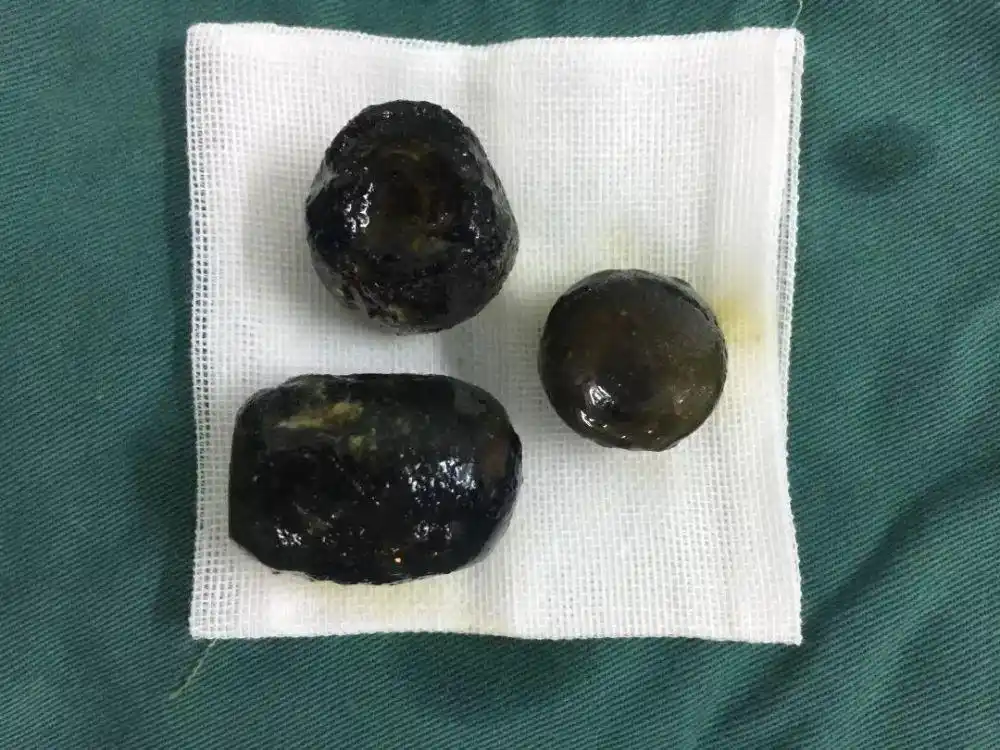 如何科学地预防胆囊结石