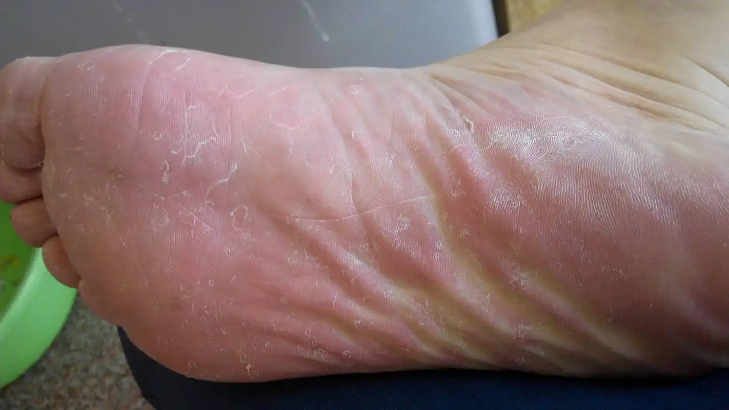 2014-07-26 朱福印 医师 脚板底脱皮了,有点痒,用啥药好呢?