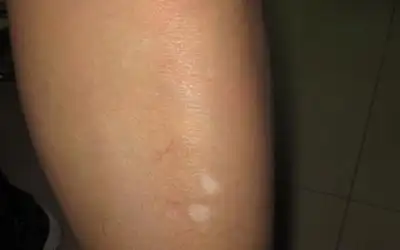 小腿上绿豆那么大的白点是什么