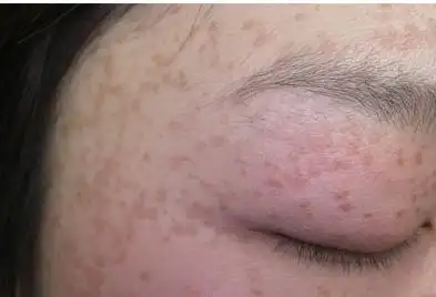 面部扁平疣怎么引起的