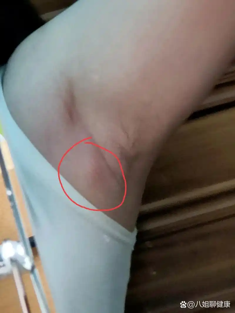 今早起来发现腋下长了一个小肿块,又红又肿,按下去还很疼,一查百度