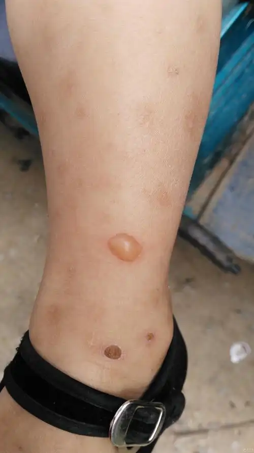 三岁**小腿(靠近脚踝部位)水泡 - 皮肤及性传播疾病讨论版 - 爱爱医