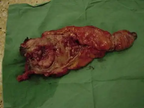 大肠癌晚期吃什么好