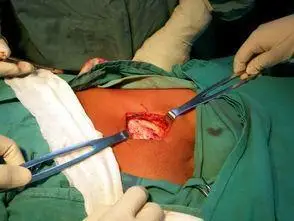 是个小手术,可能会有轻微疼痛,刀口感染等问题,但不会损伤和影响身体