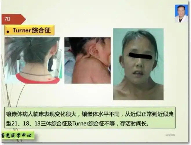 染色体病之特纳综合征/45,xo - 好大夫在线