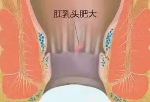别小看它_肛门_疾病_治疗