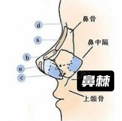隆鼻前如何判断是否需要做鼻支架塌鼻子朝天鼻必看