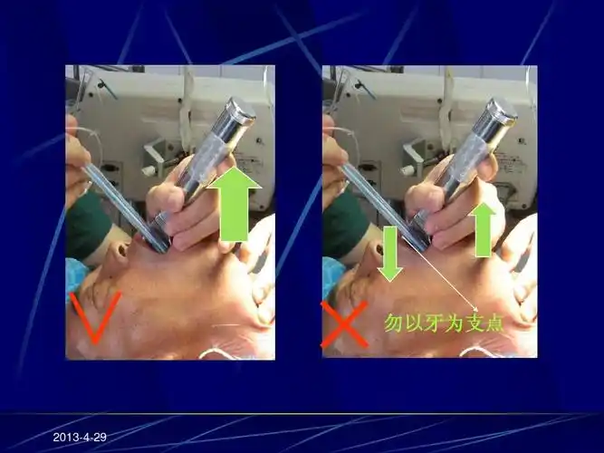 气管插管术幻灯ppt