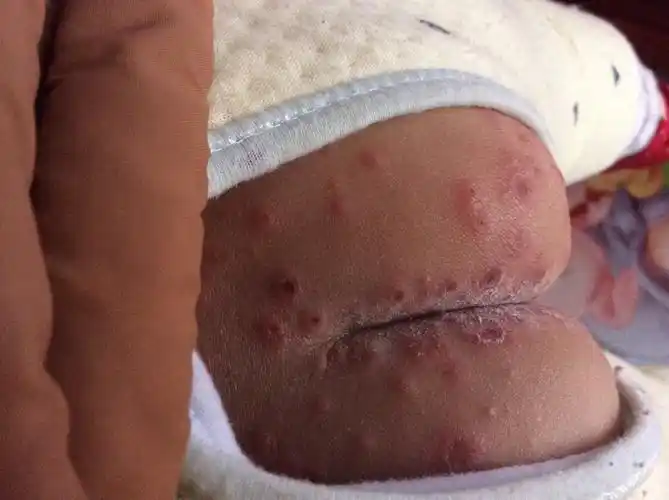 宝宝一岁了,前两天感冒了,吃药后一天拉几次,屁股长了好多疮,吓坏我了