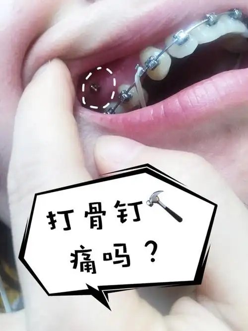 为什么正畸医师要让你打支抗钉戴牙套打骨钉痛吗