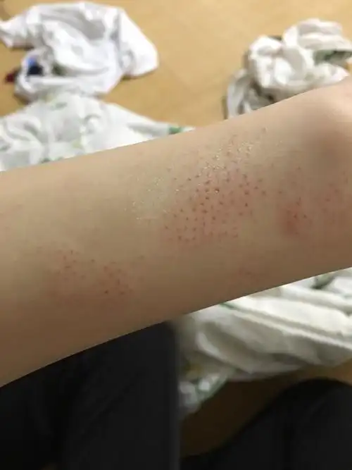 用脱毛膏用完手就成这样了,好像是灼伤?不知道是不是和我用的时间