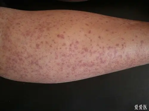 皮肤及性传播疾病讨论版 - 爱爱医医学论坛