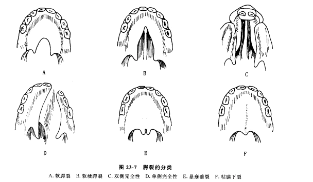 兔唇患儿(唇裂)什么时候做手术?修复有哪些要求?