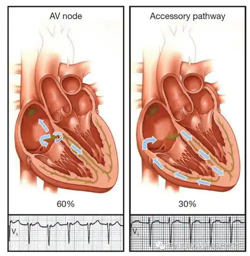 房室结主要起延迟传导的作用,若该功能异常(短pr综合征)便会影响心室