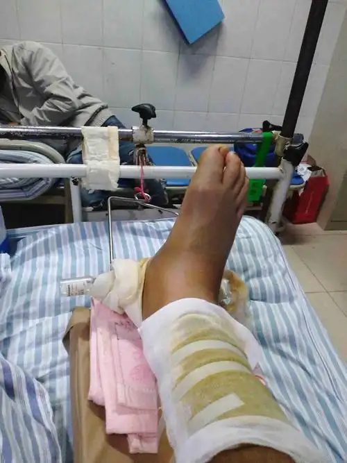 在成都工地上摔成粉碎性骨折,叫老拿钱不给,他只交一万,不够,急动手术