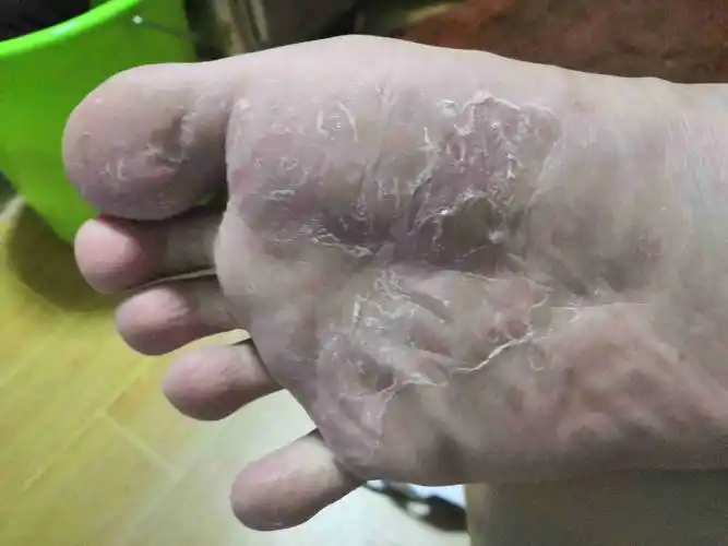 脚上蜕皮发痒,是什么原因?