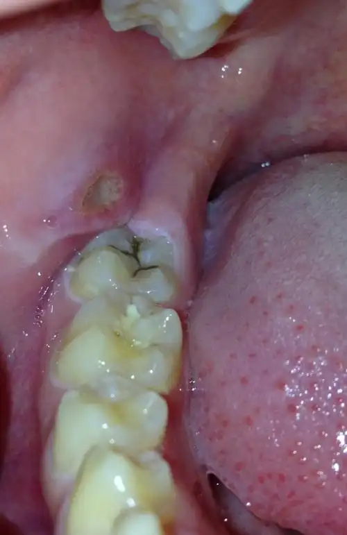 最里面的牙齿旁边长了肉 有脓
