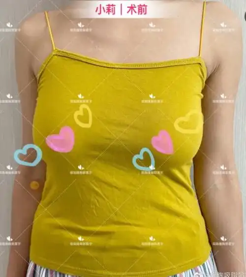 小莉产后胸部干瘪下垂做悬吊假体