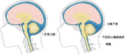 一文了解小脑扁桃体下疝畸形的临床特点及治疗策略_小脑扁桃体下疝