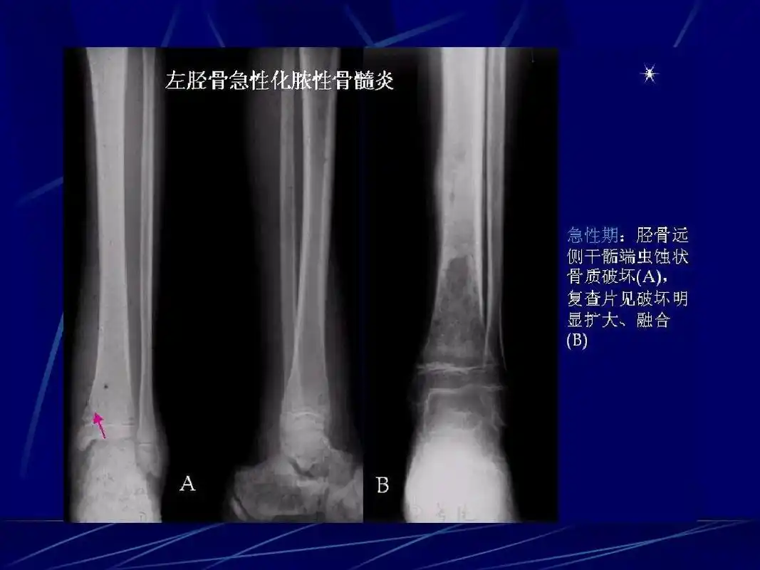 化脓性骨髓炎的影像学诊断ppt